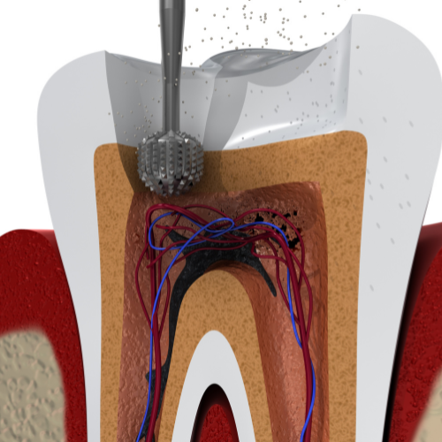 Best Root Canal Treatment in Gurgaon