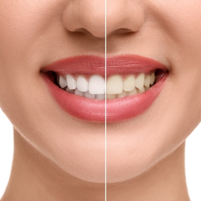 teeth whitening gurgaon