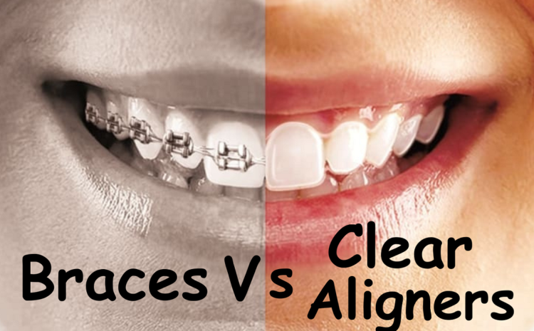  Braces or Clear Aligners – What’s the Difference?