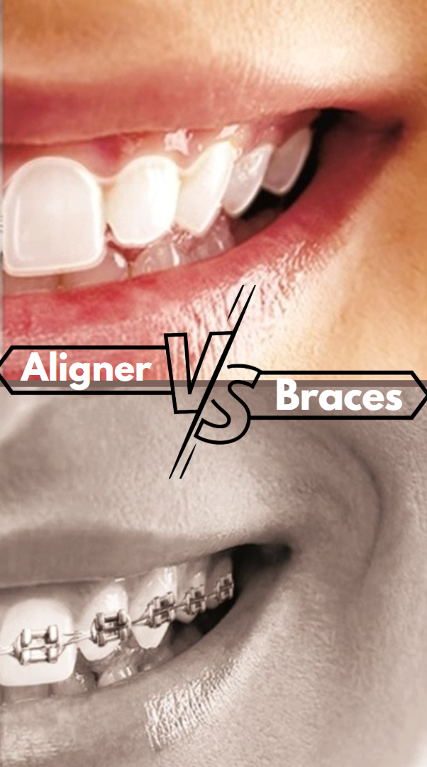 aligner vs braces