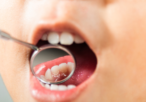 Pediatric Dentist in Gurgaon