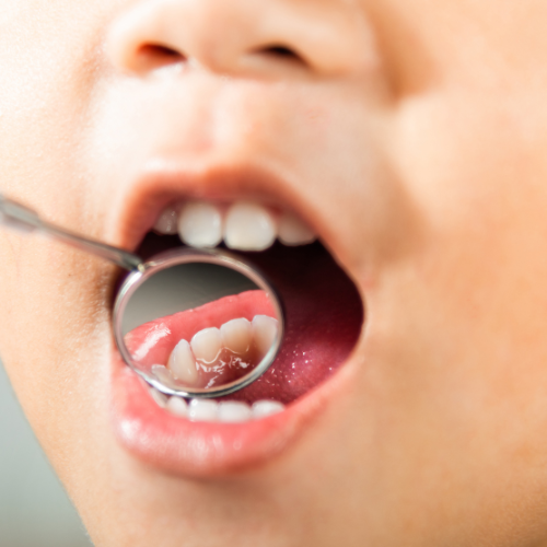 Pediatric Dentist in Gurgaon