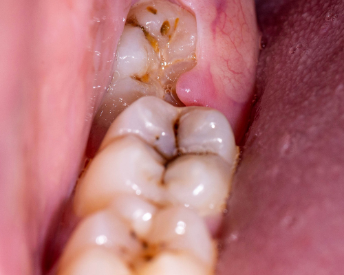 Best Root Canal Treatment in Gurgaon